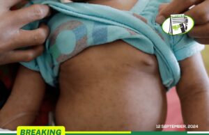 OVER 5.3M UNDER 5 CHILDREN TO BE IMMUNISED AGAINST MEASLES-RUBELLA FROM OCTOBER