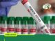 GHS CONFIRMS SECOND MPOX CASE